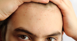 4 Easy Anti-Acne Tips