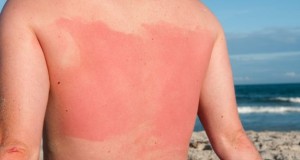 How To: Calm Sunburned Skin